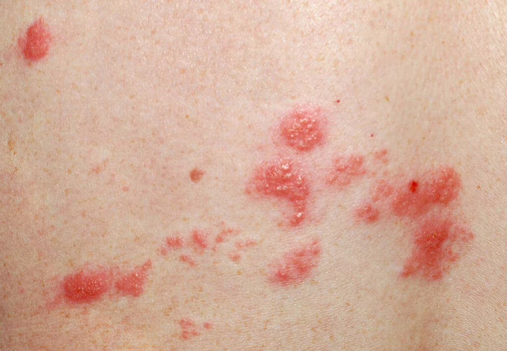 Herpes Zoster