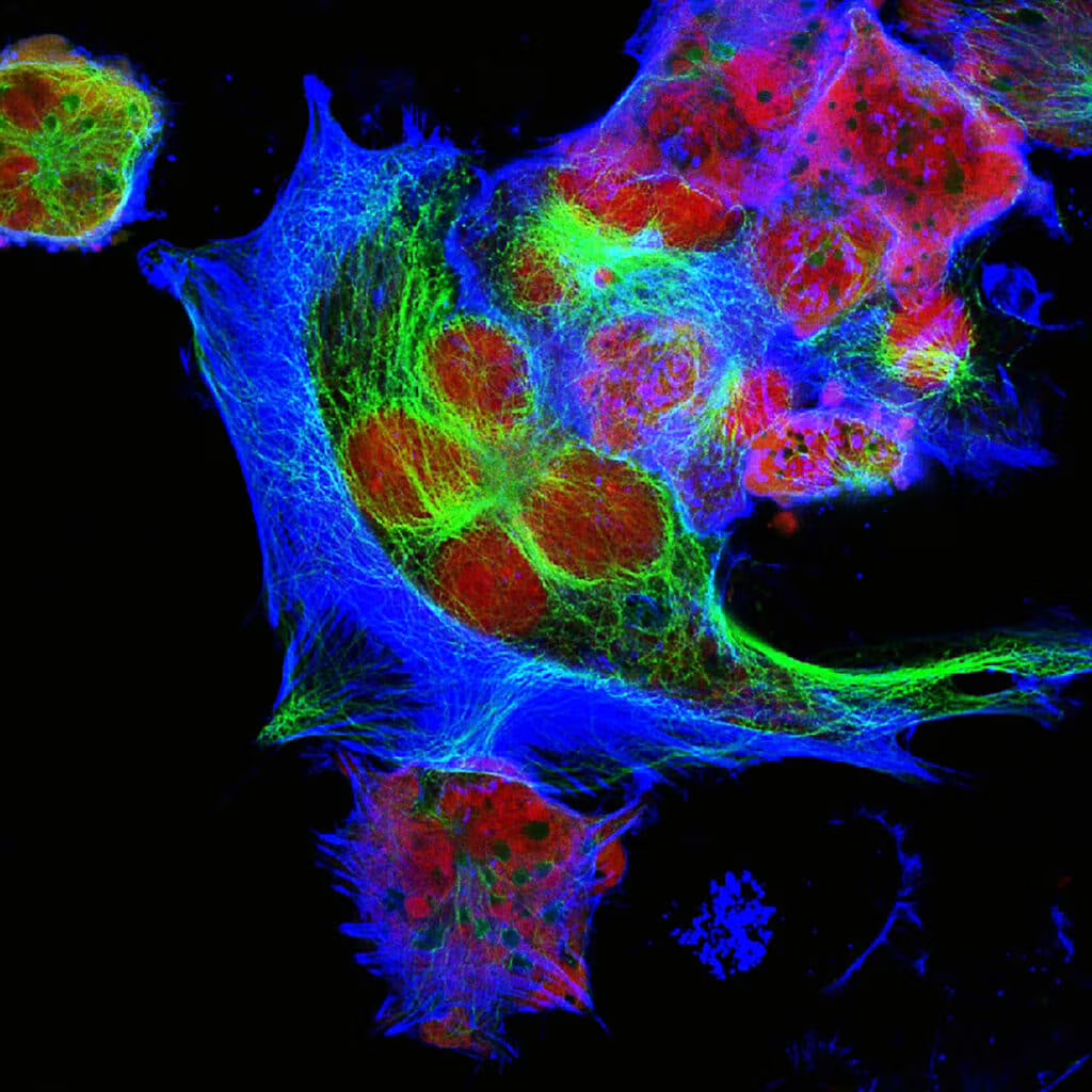 neuroblastoma