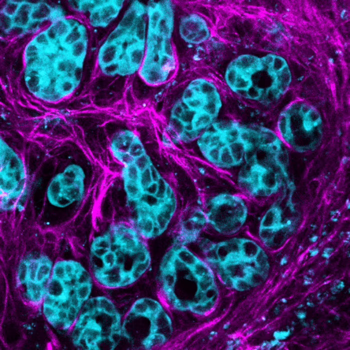 cancro al pancreas