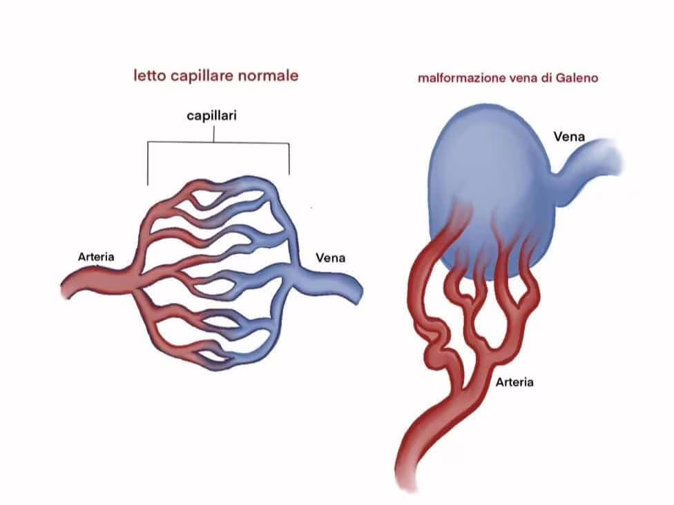 malformazione della vena di galeno