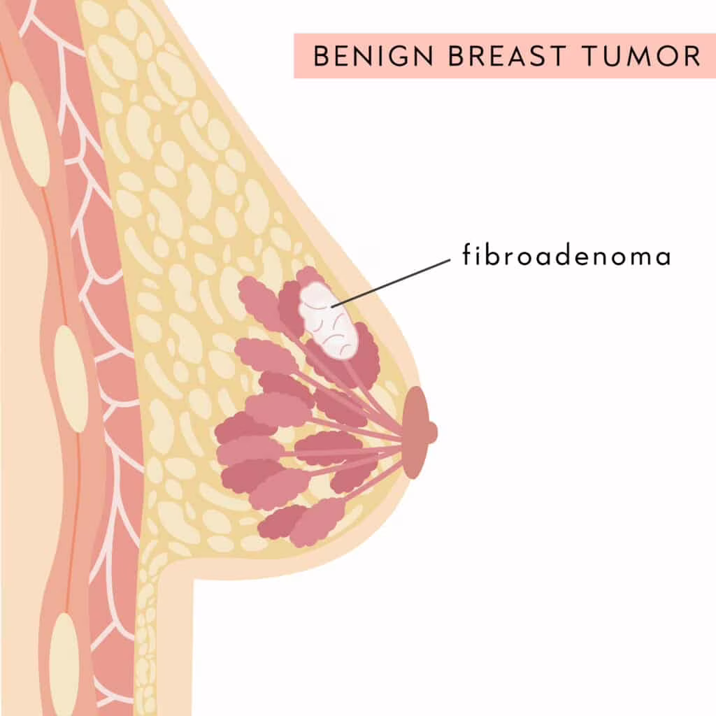 fibroadenoma