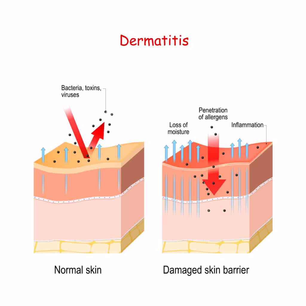 dermatite atopica