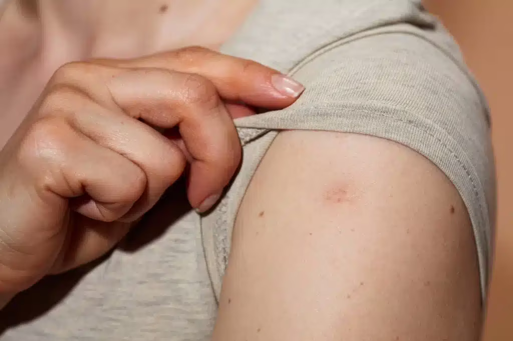 cicatrice dopo la vaccinazione del BCG