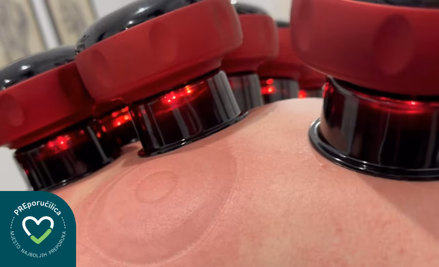 cupping blog