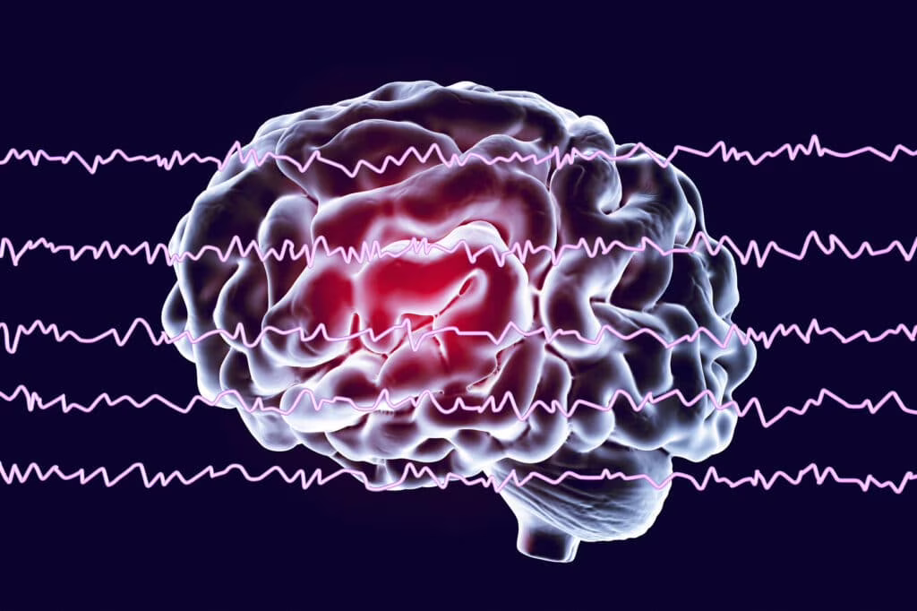 Fastball EEG e Alzheimer: una lotta contro il tempo