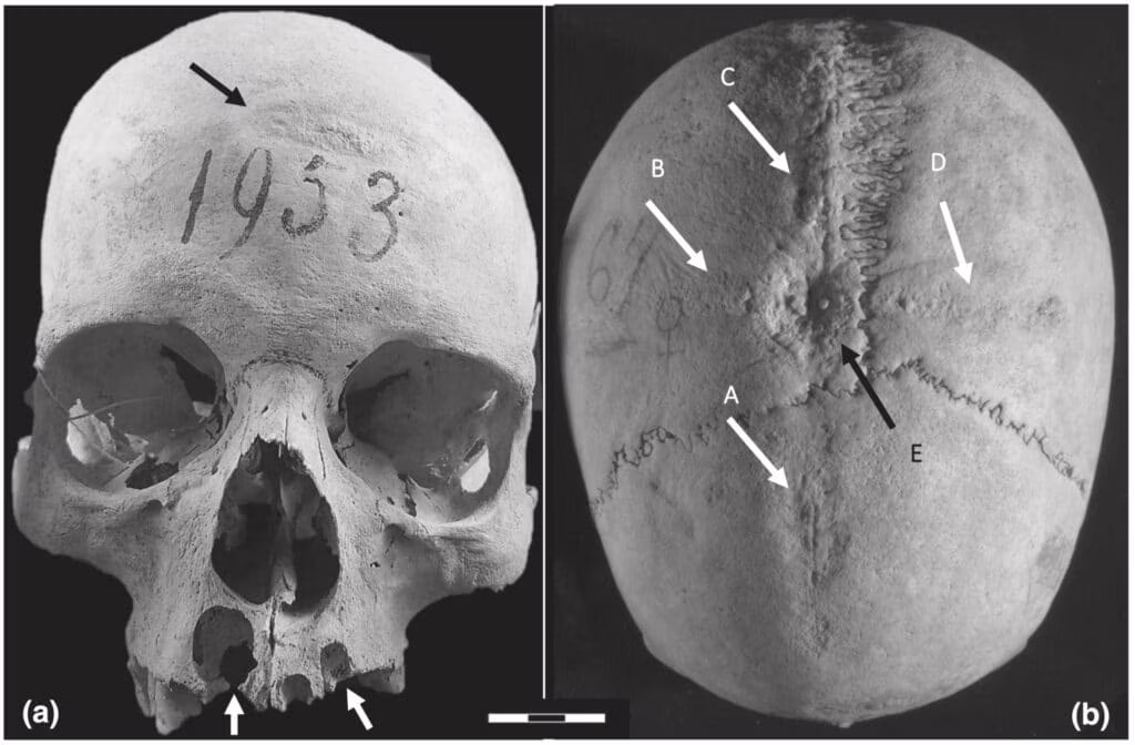 Chirurgia cranica: il primo caso nell’Italia Longobarda