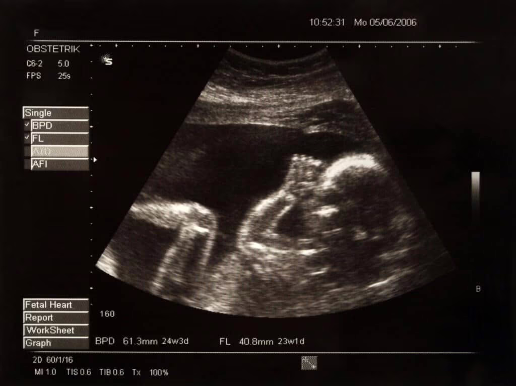 Bambino di pietra: cos’è questa gravidanza extrauterina rara