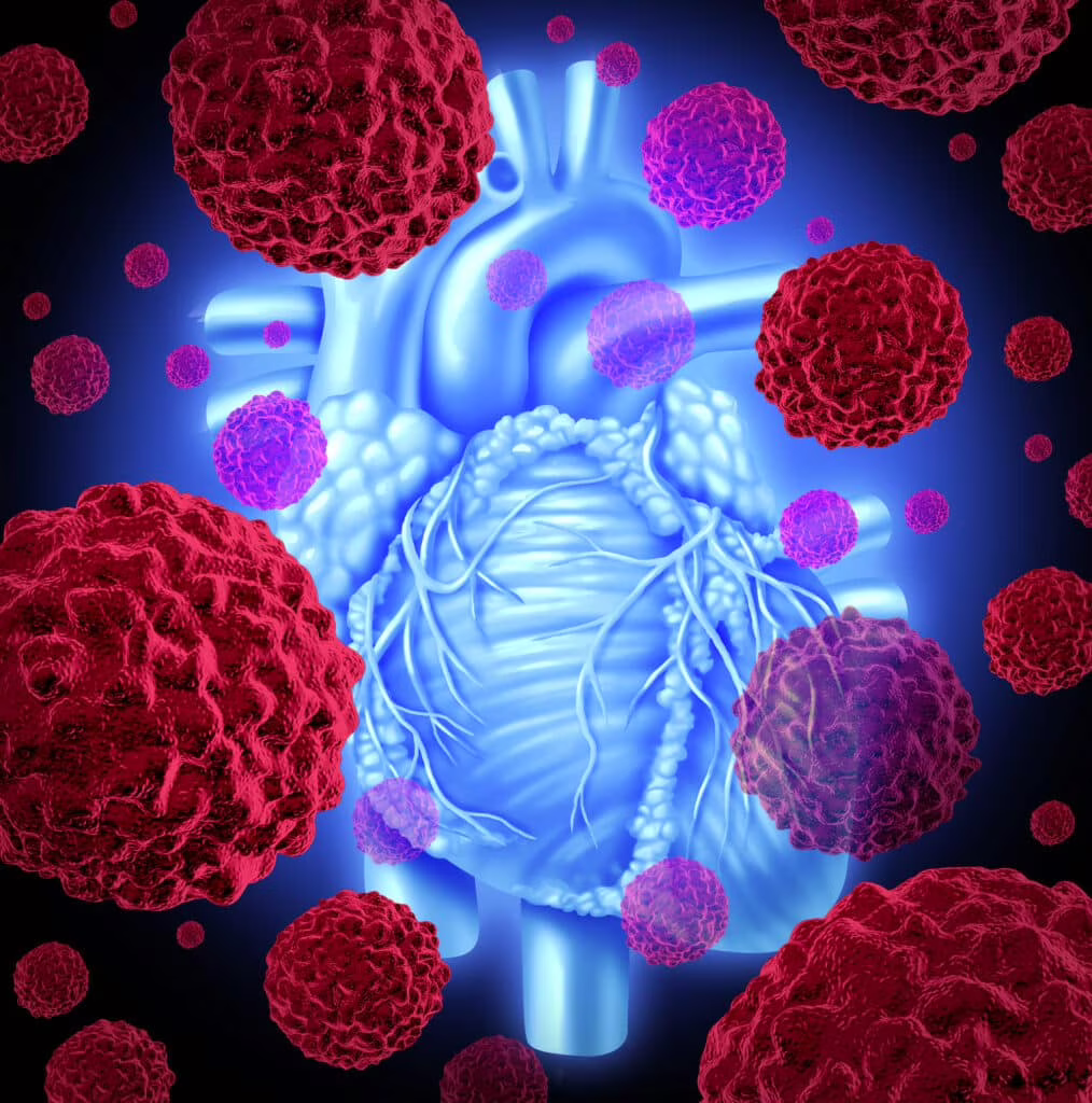 Angiosarcoma cardiaco: cos’è il tumore al cuore ultra raro