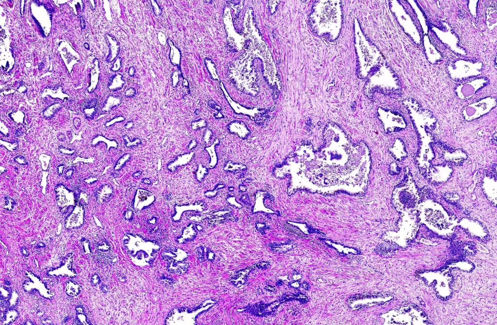 Cancro alla prostata: scoperti nuovi biomarcatori
