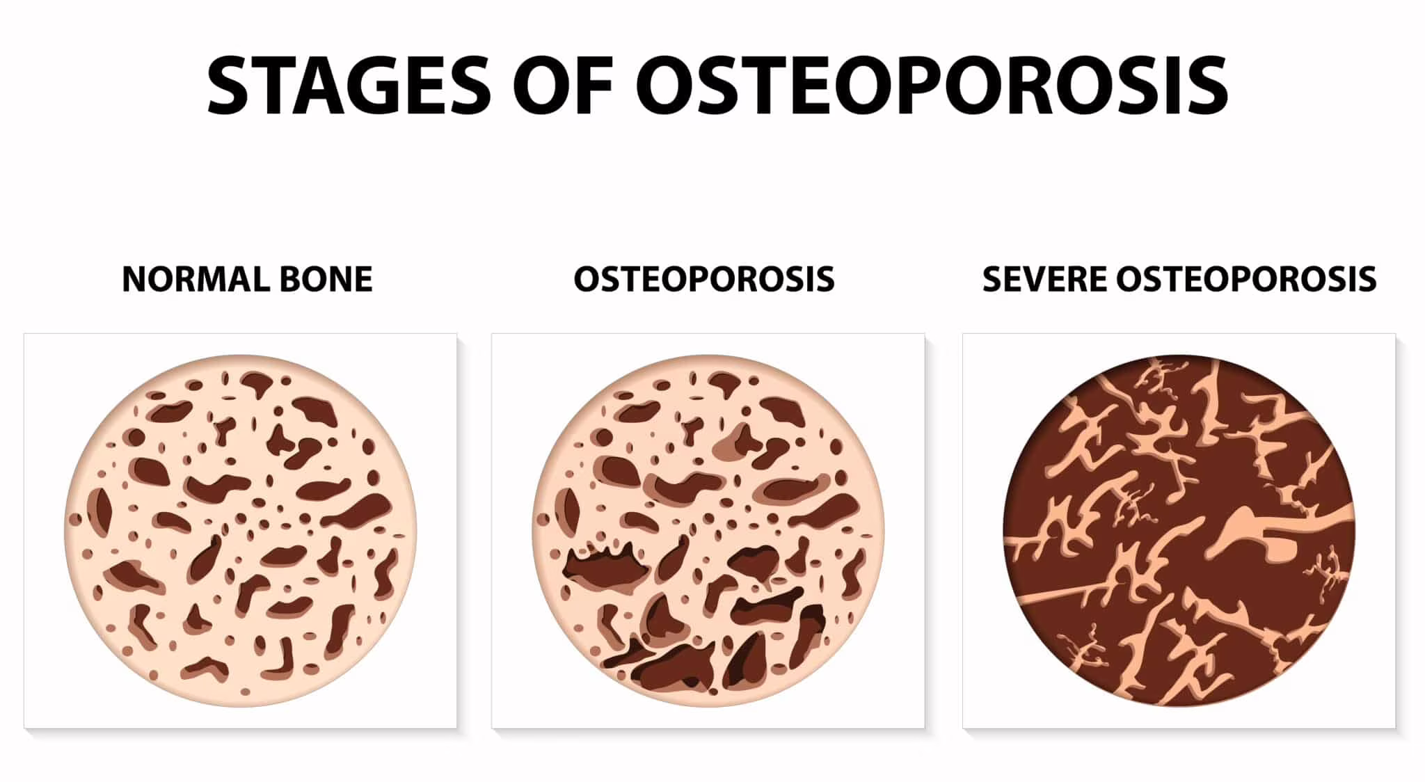 Diversi livelli di osteoporosi