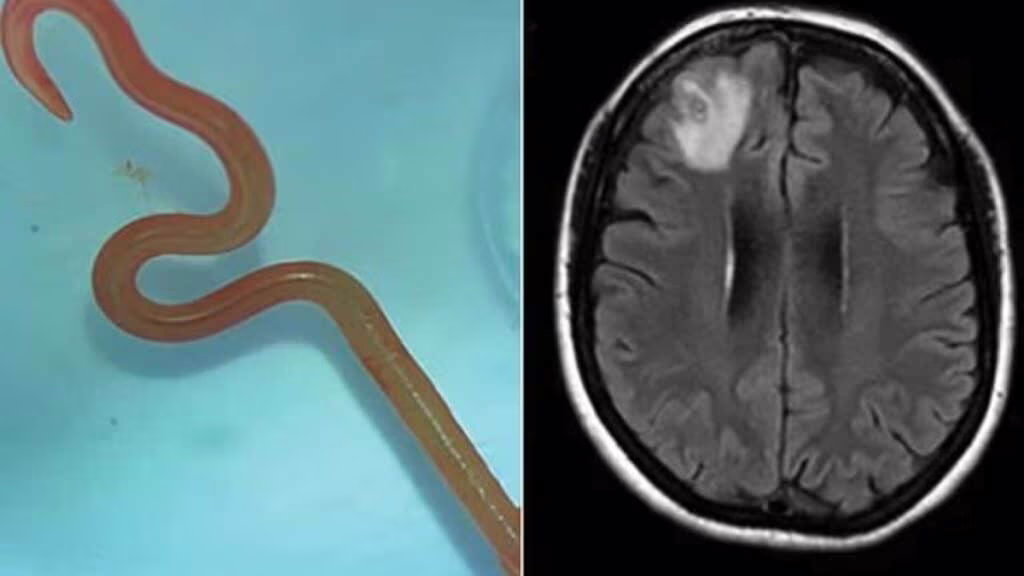 Estratto un verme di 8 cm dal cervello di una donna