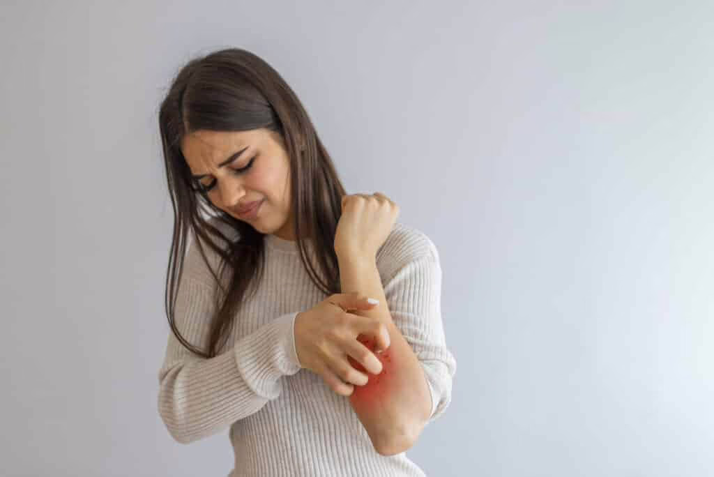 Orticaria acquagenica o “allergia all’acqua”: cos’è e come si manifesta?