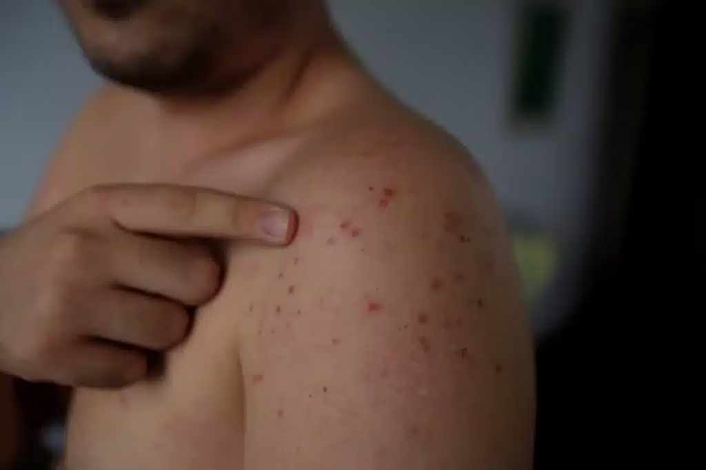 I casi di morbillo in Italia sono in aumento: calo delle vaccinazioni