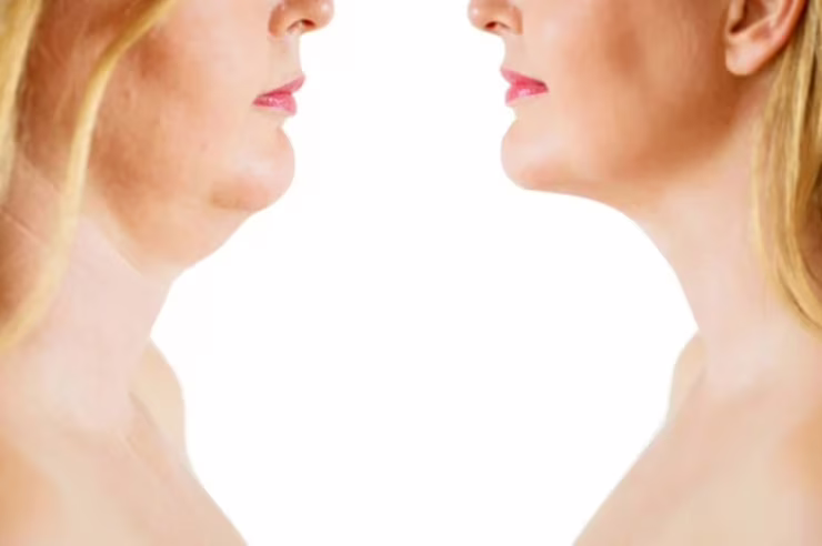 Doppio mento prima e dopo
