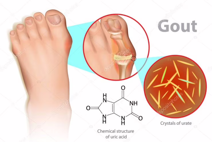 Illustrazione della gotta (Depositphotos)