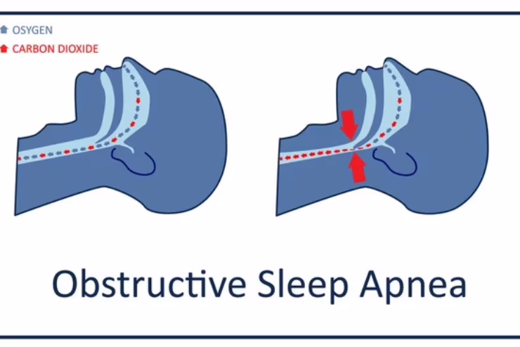 Apnee ostruttive