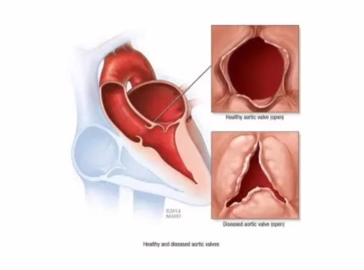 Valvola aortica (Mayo Clinic foto)