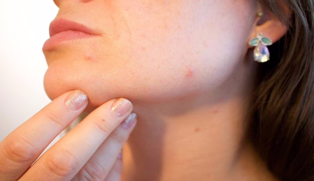 Brufoli sul viso: non serve riempire il bagno di creme costose | Con pochi euro te ne liberi per sempre in una notte