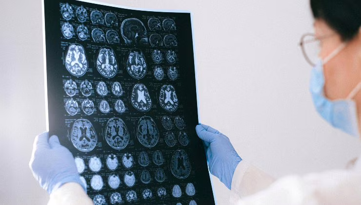 Alzheimer - (cataniaoggi.it-pexels)