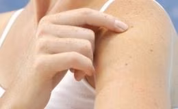 Tumore-della-pelle-non-melanoma