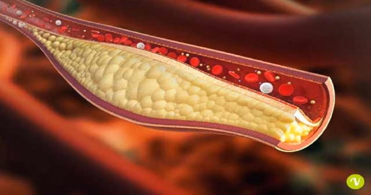 colesterolo-napoli-cura-alto-università