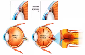 1glaucoma-removebg-preview