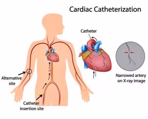 cateterismo_cardiaco