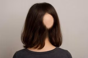 Alopecia
