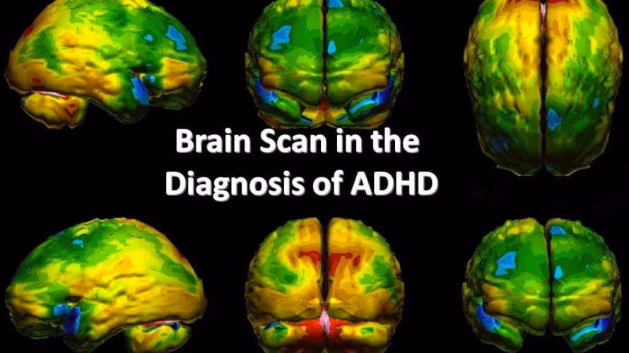 Neurofeedback terapije za motnje avtističnega spektra