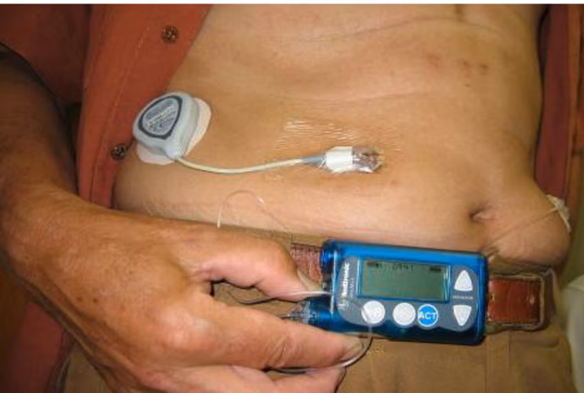 MiniMed 670G: il primo pancreas artificiale lanciato da Medtronic