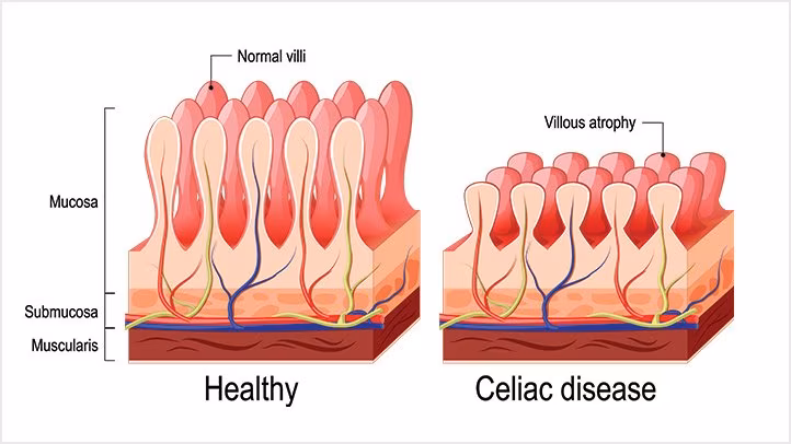 Celiachia. Credits: Shutterstock