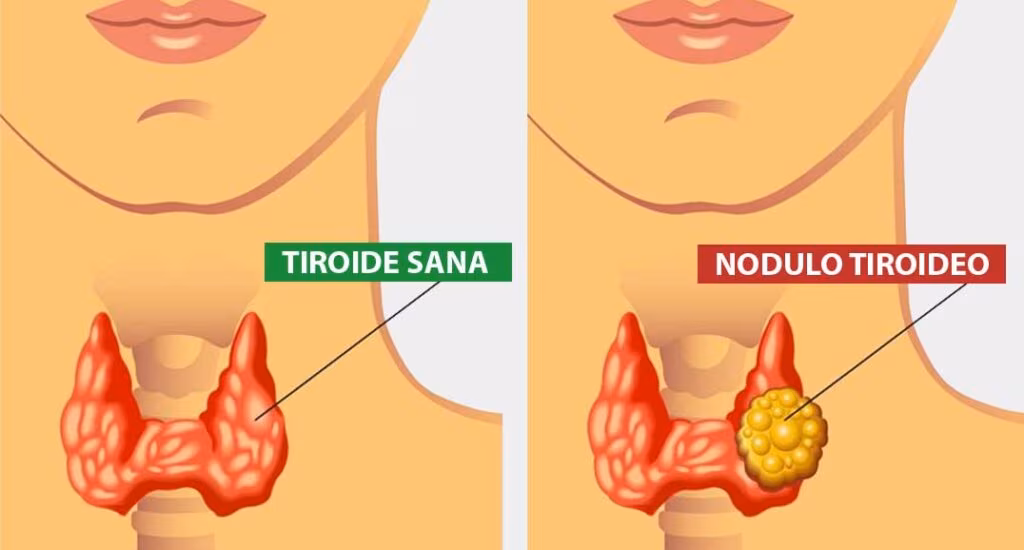 Tiroide: fisiologia, patologia e trattamenti dei disturbi. Credits: Igea S. Antimo