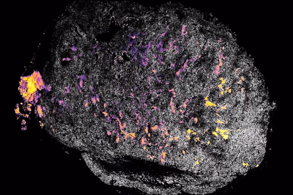 Stimolare il sistema immunitario per combattere il cancro: nuovi risultati nell'immunoterapia