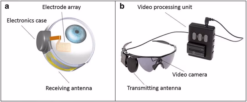 Un occhio bionico obsoleto lascia i pazienti “al buio”