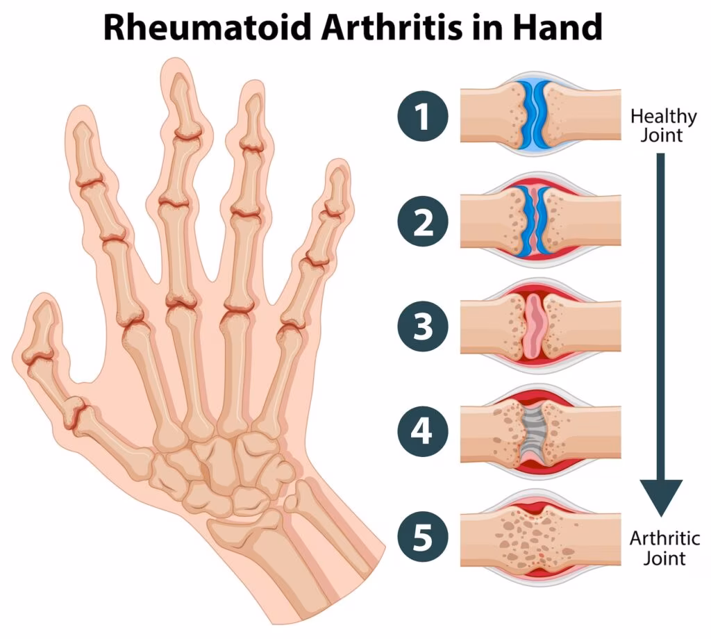 artrite reumatoide