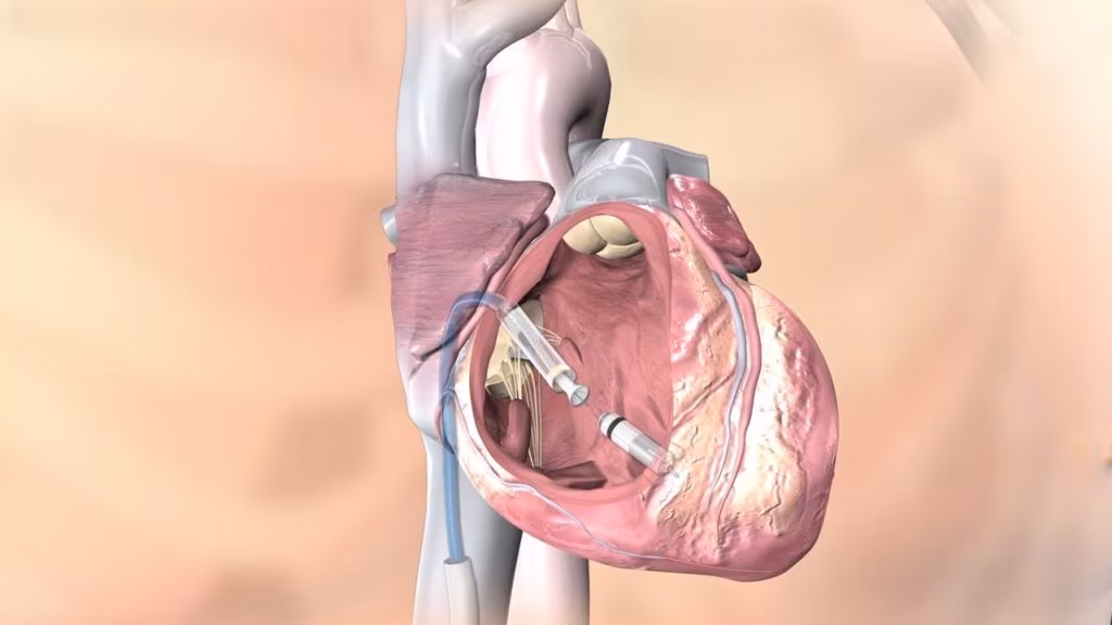 MIcra TPS:il pacemaker senza fili più piccolo al mondo