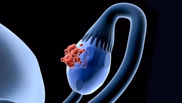 Teratomi ovarici e cisti dermoidi: cosa sono, formazione, sintomi