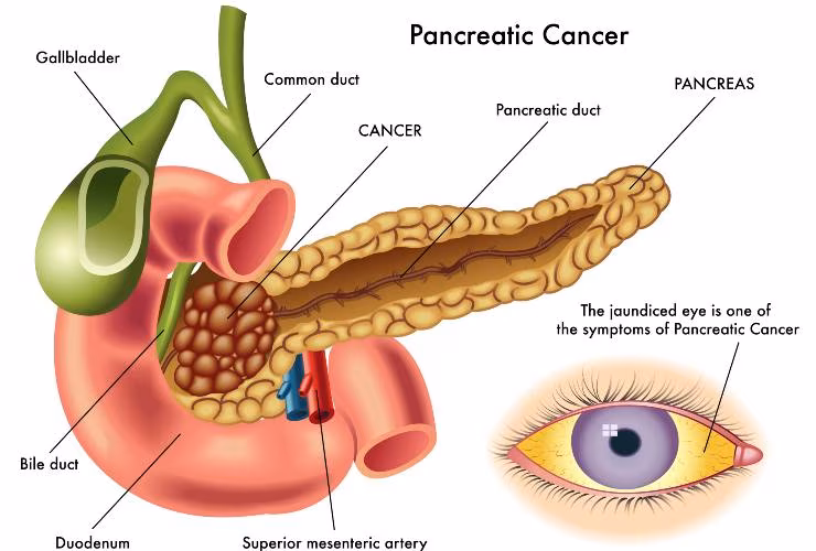 Illustrazione di un tumore al pancreas (Depositphotos)