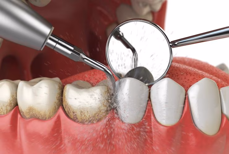 Illustrazione di una pulizia dentaria (Depositphotos)