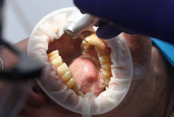 Illustrazione di un'otturazione dentale (Pixabay)