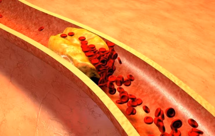 Illustrazione del colesterolo nelle arterie (Depositphotos) (1)