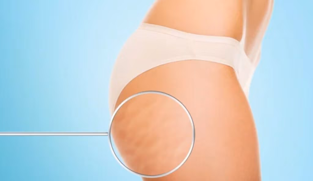 Cellulite e rimedi (Depositphotos foto)