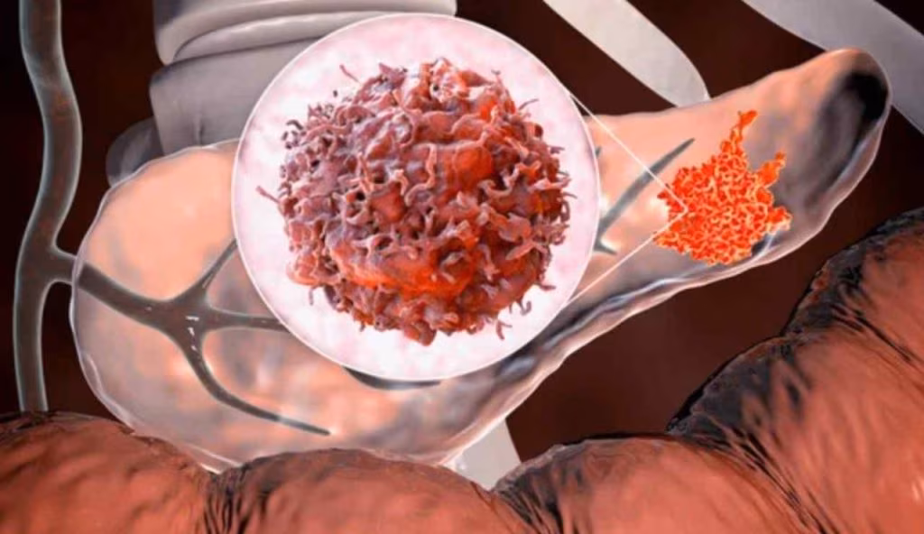 Tumore al pancreas (Depositphotos foto)