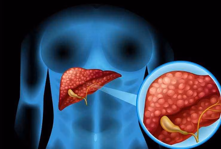 Problemi al fegato