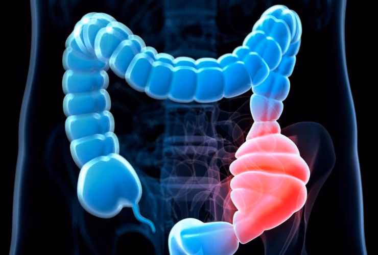Illustrazione di un tumore al colon (Canva FOTO) -biomedicalcue.it