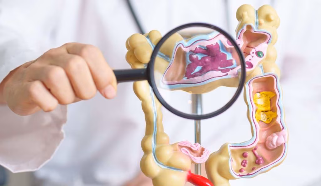 Illustrazione di un tumore al colon (Canva FOTO) - biomedicalcue.it