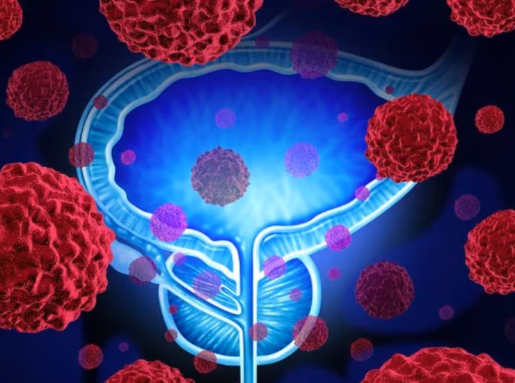 Illustrazione di cancro alla prostata (Depositphotos foto) - www.biomedicalcue.it