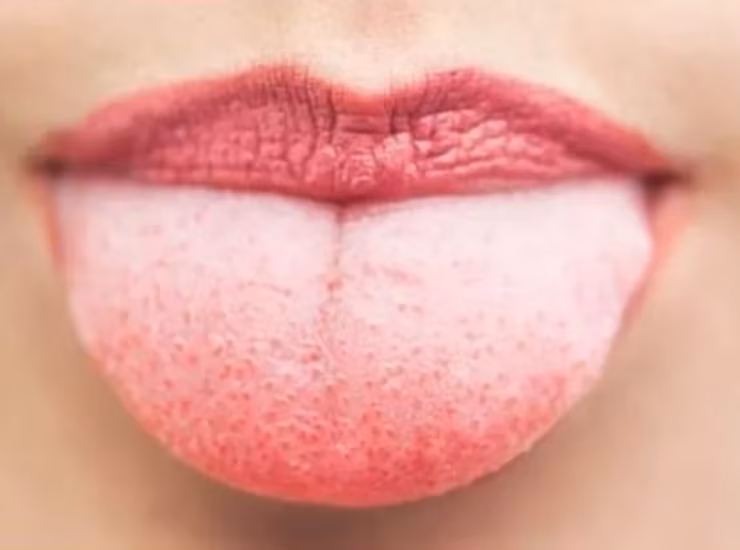 Lingua-bianca (medicalexcellencetv) - cataniaoggi